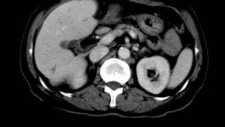 HBP C3 Cholangitic abscess Contrast