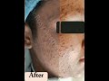 ဝက်ခြံ၊အဆီဖု၊ပြည်ဖုများကိုကုသပြီး acne acnescar blackspots largepore sensitiveskin skincare