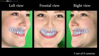 Model Based Teeth Reconstruction