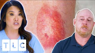 Unknown Red Patch On Man’s Leg Gets A Diagnosis After 12 Years | Dr Pimple Popper: This Is Zit