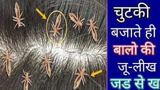 head lice | nits | सिर की जुएं-लीख 1 बार के इस्तेमाल से ख़तम | बालों के लिए / Lice Removal at Home