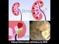 Kidney Stone Laser Lithotripsy by RIRS