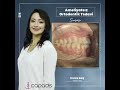 yetişkin hastada ameliyatsız ortodontik tedavi non surgery orthodontic treatment of an adult patient