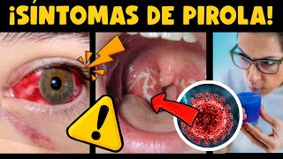 ¡ALERTA! CIENTÍFICOS ALERTAN SÍNTOMAS VARIANTE PIROLA !!!