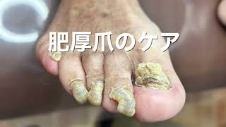 腰椎を骨折して爪が切れなくなってしまったお客様【肥厚爪のケア】