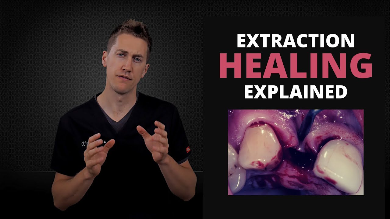 Normal Tooth Extraction Healing Process