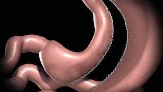 Sleeve Gastrectomy Animation