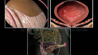 Surgical treatment of OAB - Animated Atlas of BPH and OAB