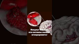 Инсульт: первые признаки, которые НЕЛЬЗЯ ИГНОРИРОВАТЬ!  #здоровьеидолголетие