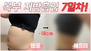 [#소코다이어트] 지방흡입 7일차! 아니 이게 말이 되냐고요,,,7일만에?!!!