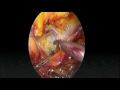 e tep repair of supraumbilical hernia