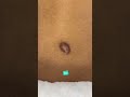 KELOID SCAR REMOVAL - DR. TANVEER JANJUA- NEW JERSEY