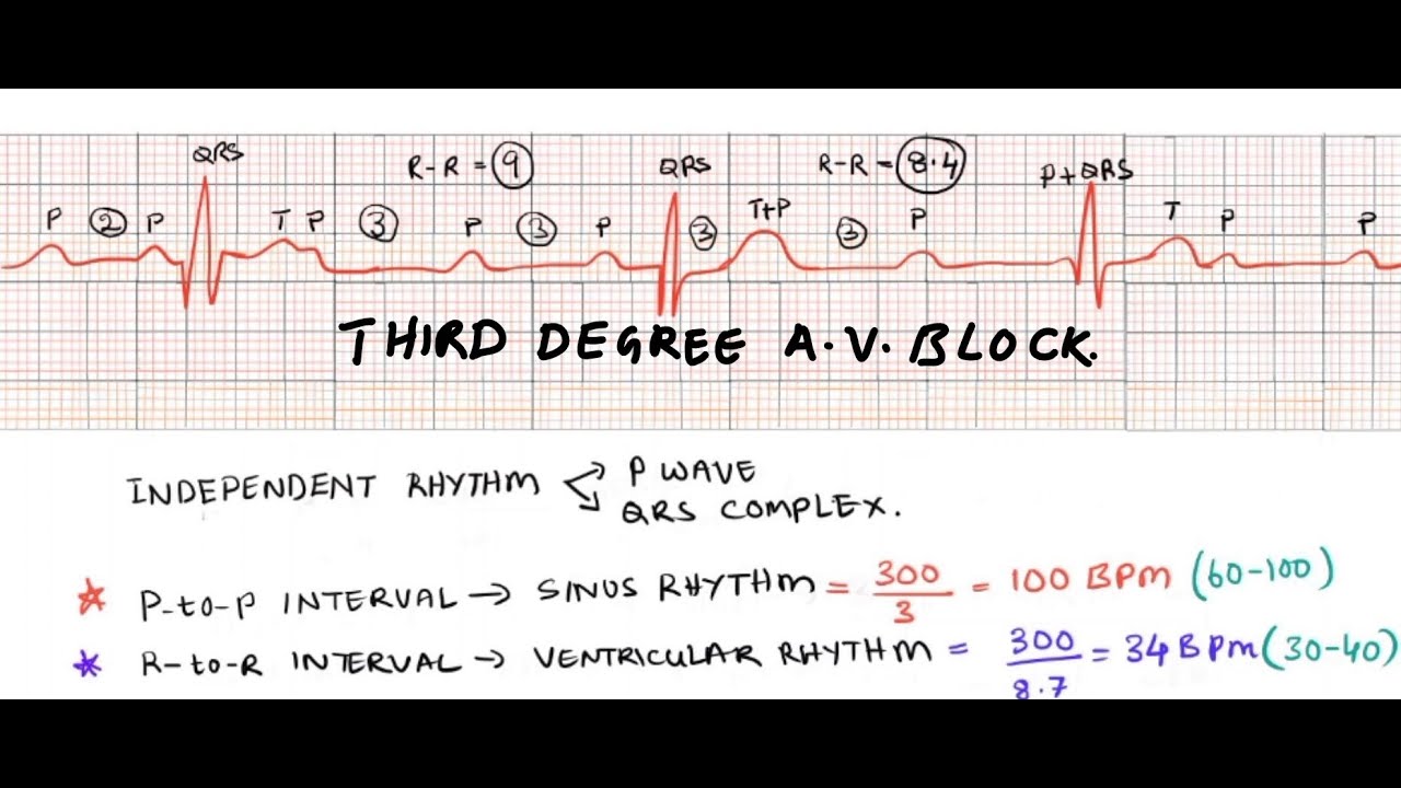 Third Degree Av Block 3rd Degree Av Block Av Block 3 Av 40 Off