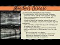 breast ultrasound pathology gallery mondor s disease