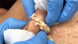 Stubborn Sac and Cyst Removal | CONTOUR DERMATOLOGY
