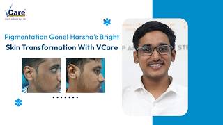 From Pigmentation to Bright, Confident Skin: Harsha’s Success Story with #VCare