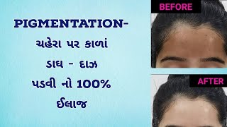 pigmentation - ચહેરા પર કાળાં ડાઘ- દાઝ પડવી નો 100% ઈલાજ 💥