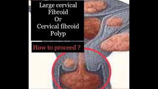 Large Cervical Fibroid Polyp Excision