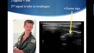 Confirming Endotracheal Tube Placement with Ultrasound