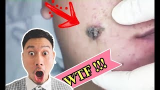 WTF ! HOW REMOVING MONSTER ACNE IN FACE