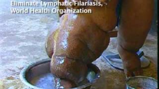 Elephantiasis Afflicts 120 Million in Africa, Asia