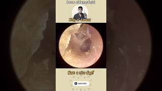 @귀지형 #귀지#귀지제거 #귀파기 #귀파기asmr  #귀청소 #이비인후과 #earwax #earwaxremoval  #asmr #ENT #ENTdoctor