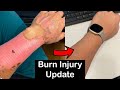 Long Term Healing Progress Of Second Degree Burns (3 Year Update)