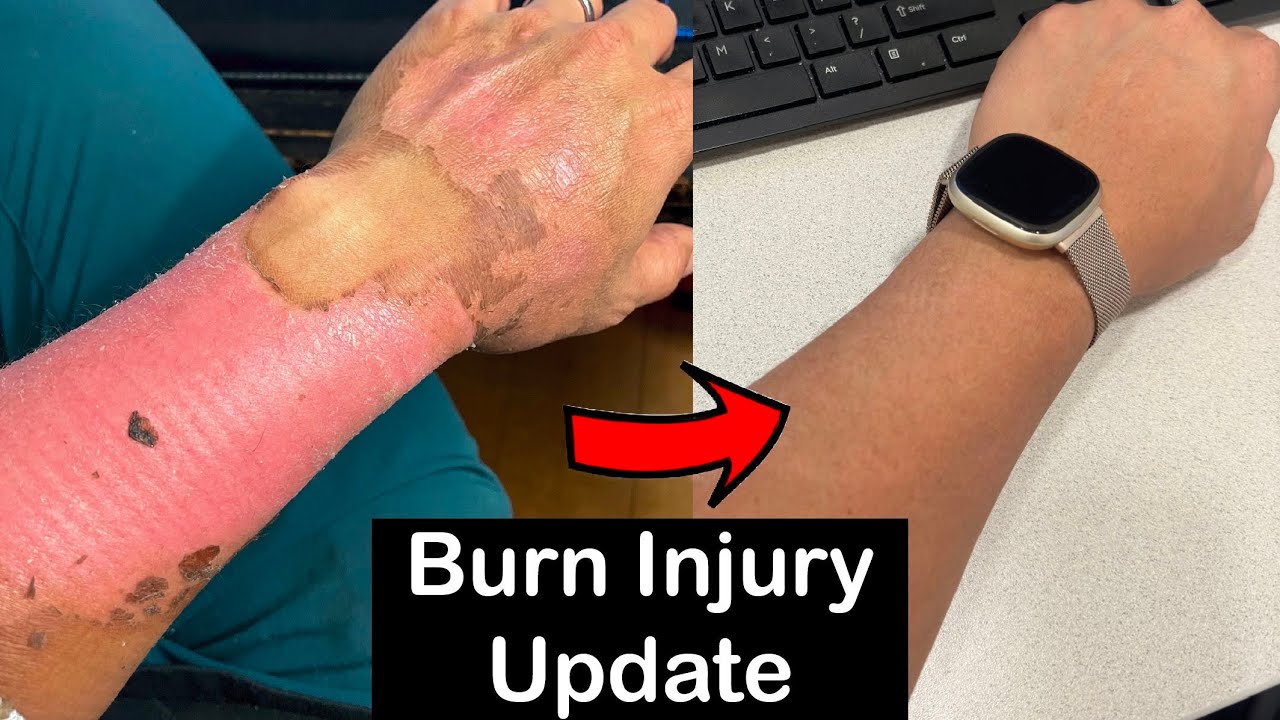 Long Term Healing Progress Of Second Degree Burns (3 Year Update) - YouTube