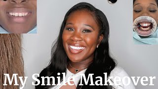 MIAMI SMILE MAKEOVER: MY EXPERIENCE WITH DENTAL DESIGN SMILE'S COMPOSITE RESIN VENEERS | ALEXIS A.