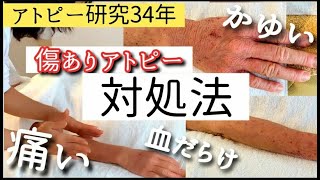 【傷ありアトピー(1/3)】「痒い」「痛い」ときのおすすめ対処法【アトピー研究34年ノウハウ】