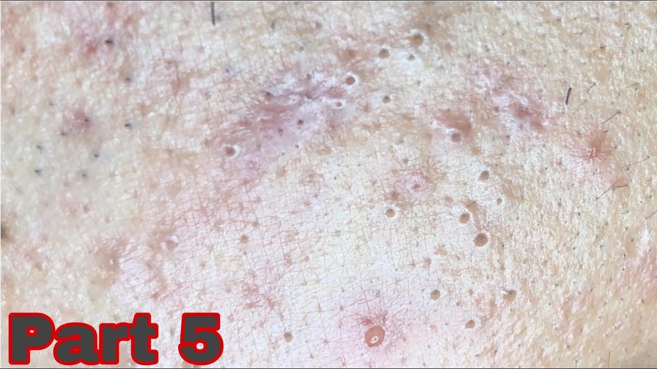 #5 Blackheads .. Customers Have The Most Acne | B'Young Spa | Nặn Mụn ...