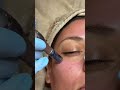 scopri l esperienza microneedling exclusive di yanabeauté