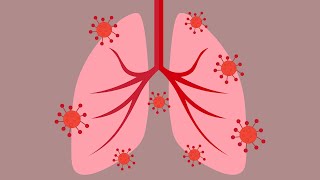 05 27 20 COVID-19 Webinar: Pulmonary Manifestations