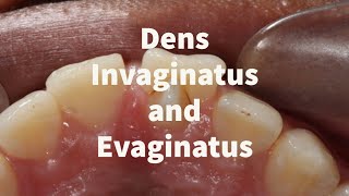 Dens invaginatus and Evaginatus (simplified)