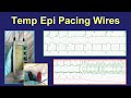 Surgical epicardial pacing wires - uses and management