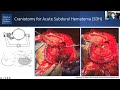 craniotomy for acute subdural hematoma