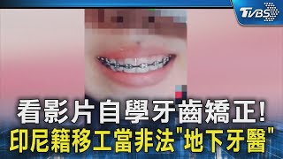 看影片自學牙齒矯正!印尼籍移工當非法「地下牙醫」｜TVBS新聞 @TVBSNEWS02