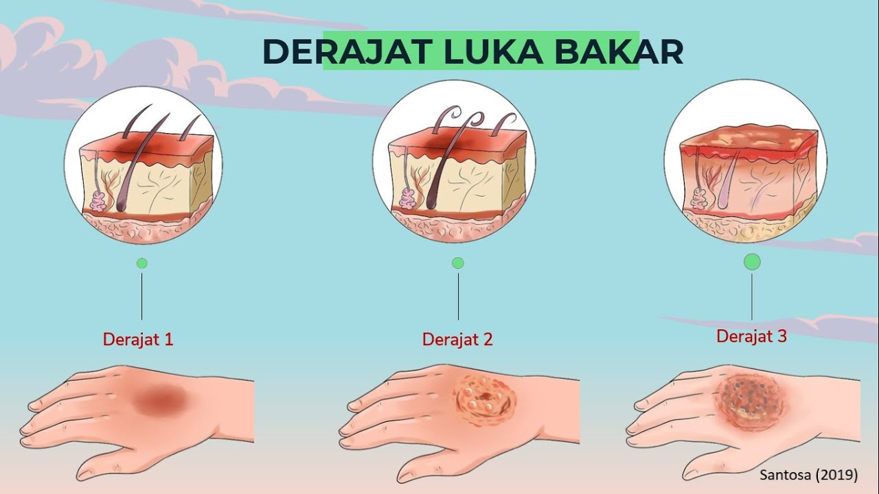 Video Animasi: Apa Itu Luka Bakar Dan Bagaimana Penanganannya? - YouTube