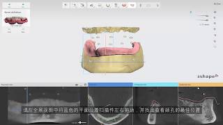 3Shape Implant Studio -无牙颌病例- 3. 如何对齐扫描件且定义牙龈