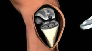 3D Medical Animation of a Knee Replacement