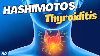 Hashimoto's Disease: Causes, Symptoms and Treatment