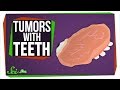 Teratomas: What Tumors with Teeth Can Teach Us About Stem Cells