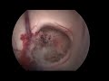 neuroendoscopic treatment of colloid cysts