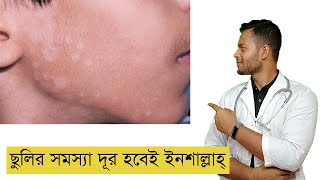 ছুলি দূর করার উপায়।ছুলির কারণ ও প্রতিকার। Estiak Shakil.