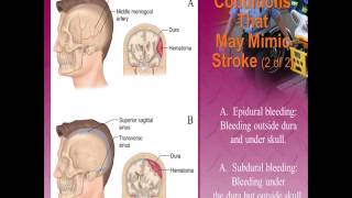 Neurologic Emergencies