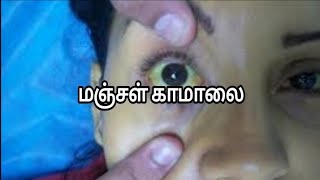 மஞ்சள் காமாலை | Jaundice Disease | manjal kamalai