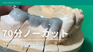 【歯科技工】exocadと歯科技工3Dスキャナー で⑦65④ブリッジワックスパターンの作り方