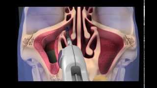Balloon Sinuplasty Animation - Maxillary Sinuses
