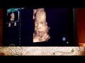 AMAZING 3D 4D Ultrasound Video 30 Weeks Baby Smiling In Womb Yawning Crying & Waving AMAZING 3D 4D Ultrasound Video 30 Weeks Baby Smiling In Womb Yawning Crying & Waving