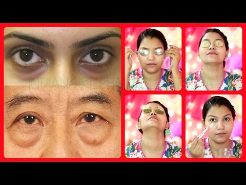 Best 5 Remedies for Puffy eyes/dark circles/eye bags/swollen eyelids (with demo) Best 5 Remedies for Puffy eyes/dark circles/eye bags/swollen eyelids (with demo)